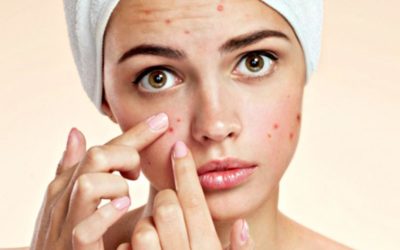 Trattamento dell’acne