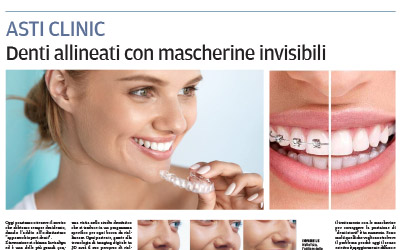 Denti allineati con mascherine invisibili