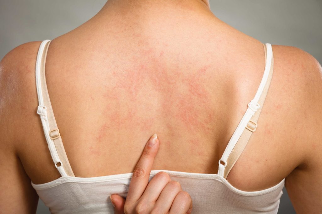 Orticaria: sintomi cause e diagnosi 