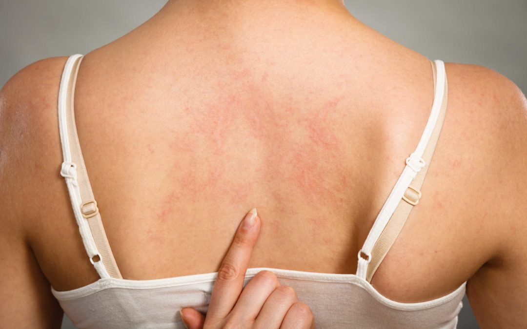 Orticaria: sintomi, cause, diagnosi